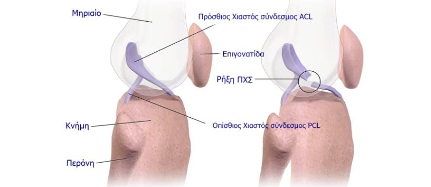 μερικη ρηξη προσθιου χιαστου