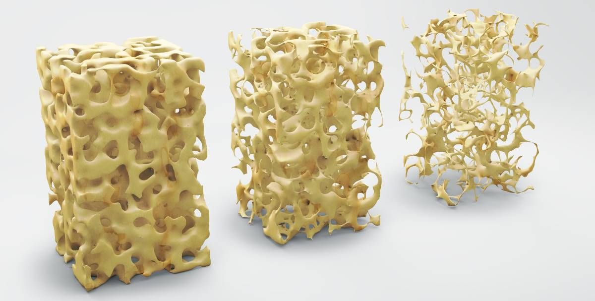 θεραπεια οστεοπορωσησ