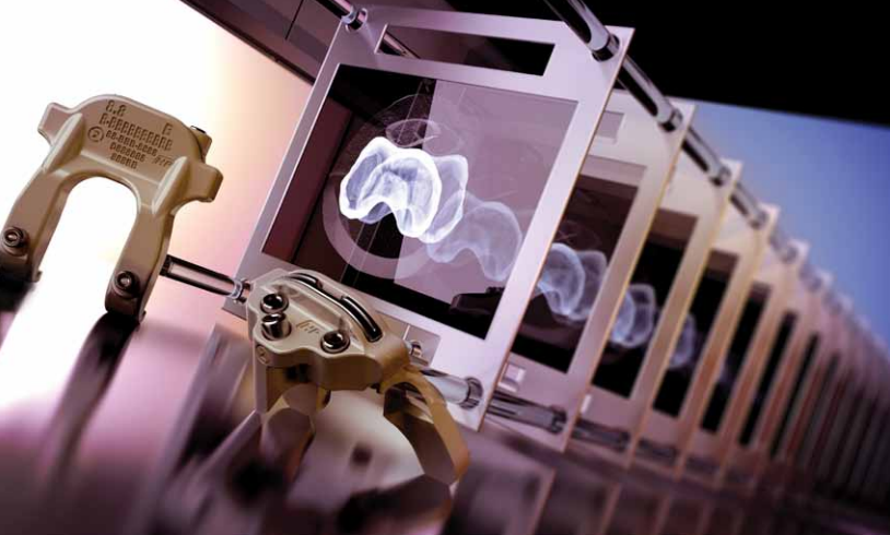 εξατομικευμενη αρθροπλαστικη γονατοσ