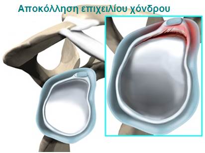 Αποκόλληση επιχείλιου χόνδρου (Labral Tear)