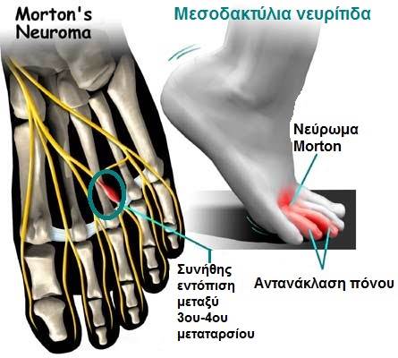 Νεύρωμα Morton