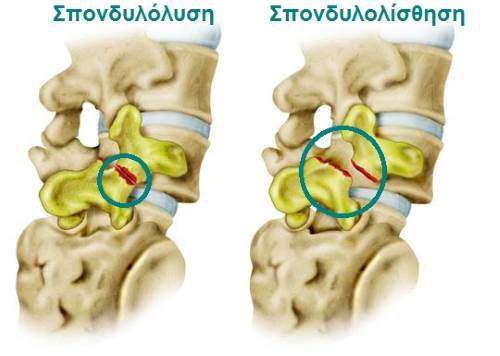Σπονδυλόλυση - Σπονδυλολίσθηση