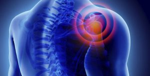 περιαρθρίτιδα ώμου